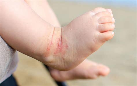 Neurodermitis Beim Kleinkind Und Baby Sanubiom