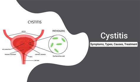 Cystitis: Symptoms, Types, Causes, and Treatment