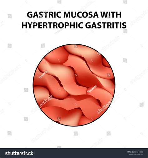 Gastric Mucosa Hypertrophic Gastritis Infographics Vector Stock Vector Royalty Free 1021276858