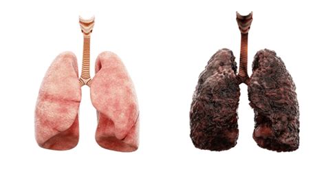 Emphysema - Facts, causes, warning signs, & management |FactDr