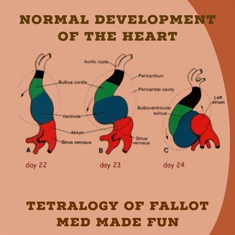 Tetralogy Of Fallot