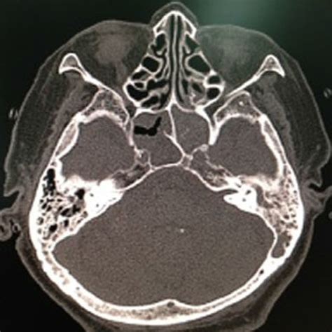 Postnasal Discharge From Left Sphenoethmoidal Recess Notes Endoscopic