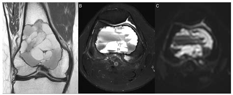 Diagnostics Free Full Text Pitfalls Of Diffusion Weighted Imaging