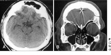 Figure From Delayed Tension Pneumocephalus Due To Rupture Of The