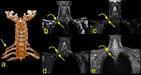 A 42 Year Old Patient With An Accessory Cervical Rib On The Right Side Download Scientific