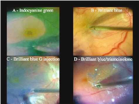 Summary Of The Ilm Peeling Techniques During The Chromovitrectomy A