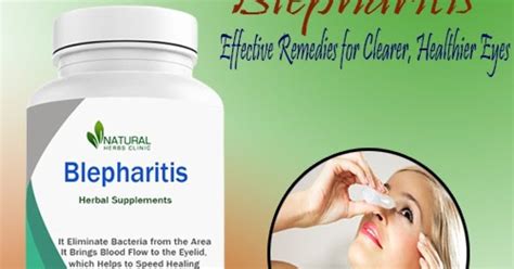 Blepharitis Natural Treatments Archives Natural Herbs Clinic Blog