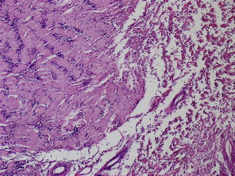 Laparoscopic Resection Of Retroperitoneal Schwannoma Near The Inferior