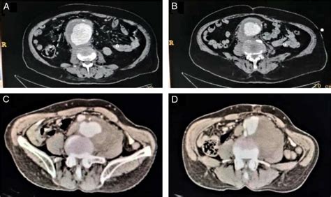 A Preoperative Contrast Enhanced Multi Slice Computed Tomography