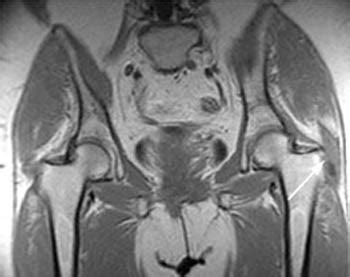 Gluteus Medius Bursitis