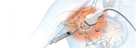 Sentinel Lymph Node Biopsy In Chennai