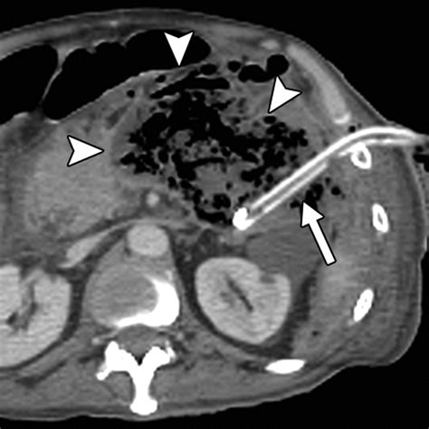 Ct Guided Percutaneous Catheter Drainage Of Acute Infectious Necrotizing Pancreatitis