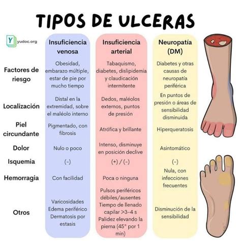 Tipos de Ulceras | YUDOC.ORG | uDocz