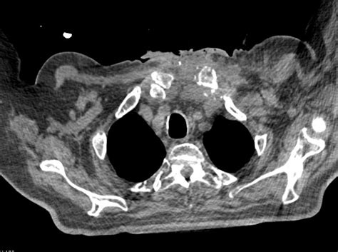 Osteomyelitis Sternum With Abscess Chest Case Studies Ctisus Ct