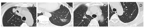 Frontiers Ct Based Radiomic Phenotypes Of Lung Adenocarcinoma A Preliminary Comparative