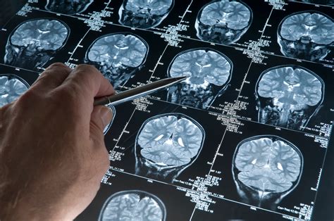 Recovery after Microvascular Decompression - Woodall Brain & Spine