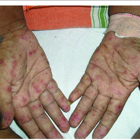 Generalized Erythematous Rash Extending To Palms And Soles Download Scientific Diagram