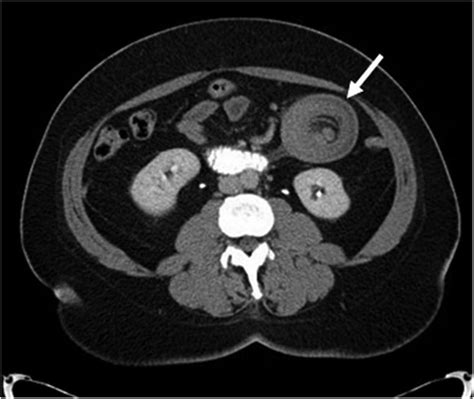 Adult Jejunojejunal Intussusception In The Face Of Jejunal