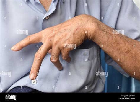 Ulnar Claw Hand Of Asian Elder Man Also Known As Spinster Claw