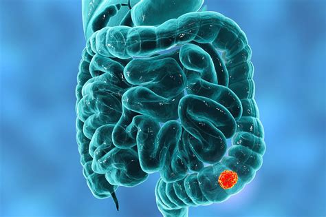 The Importance Of Screening For Bowel Cancer Symptoms | Direct Endoscopy