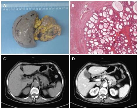 Current Perspectives On Pancreatic Serous Cystic Neoplasms Diagnosis