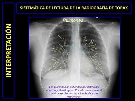 Diagnóstico Por Imágenes Radiografía De Tórax Normal