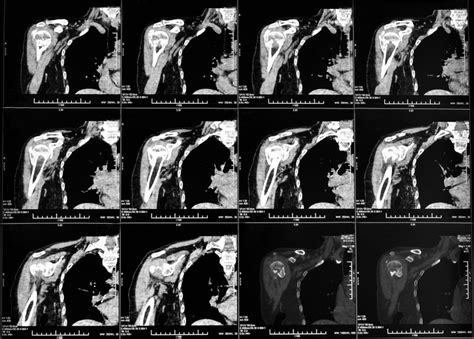 What Is A Shoulder CT Scan Two Views