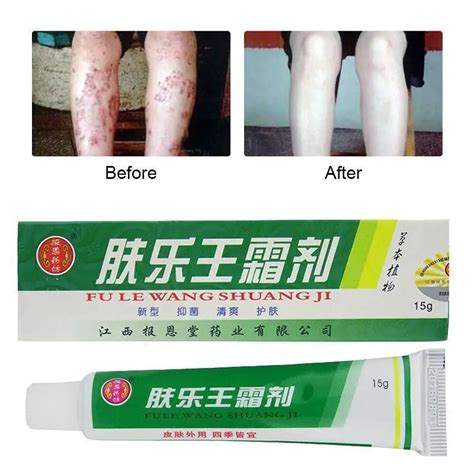 100 Chinese Herbal Skin Topical Antipruritic Ointment Cream Analgesic