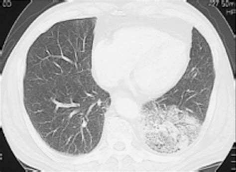 [pdf] Ct Findings Of Pneumonic Type Adenocarcinoma Comparison Between Invasive Mucinous