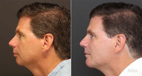 Chin Implants Photos | Princeton, NJ | Patient 8640