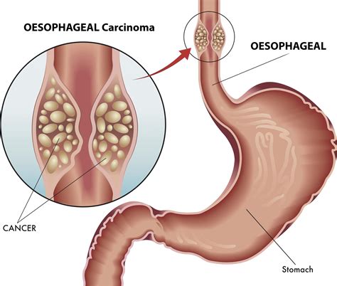 Oesophagus Cancer