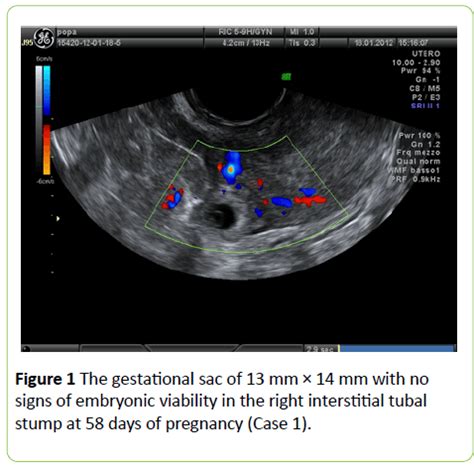 Ectopic Pregnancy Of The Tubal Stump In Art Patients Two Case Reports