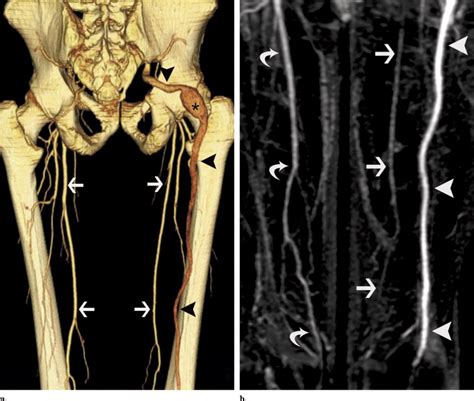 Persistent Sciatic Artery Aneurysm Journal Of Vascular And