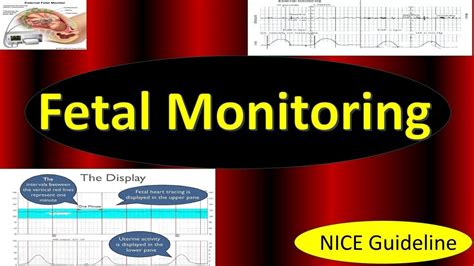 Fetal Monitoring In Labor NICE Guideline 2022 Updates In