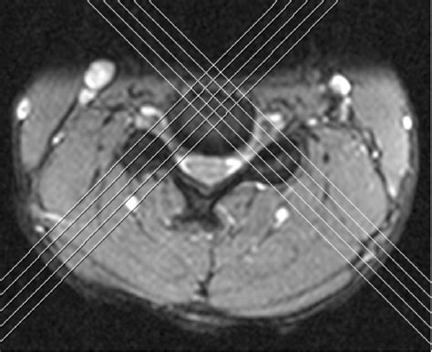 Coronal Oblique Orientation Offers Improved Visualization Of