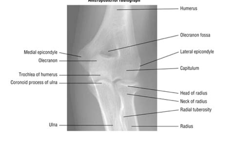 AP Lat Medial Oblique Elbow Positioning Flashcards Quizlet