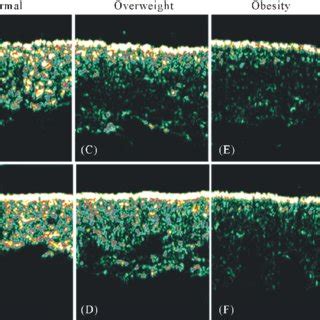 Typical Structure Of Dermis In Ultrasonographic Images By The Mhz