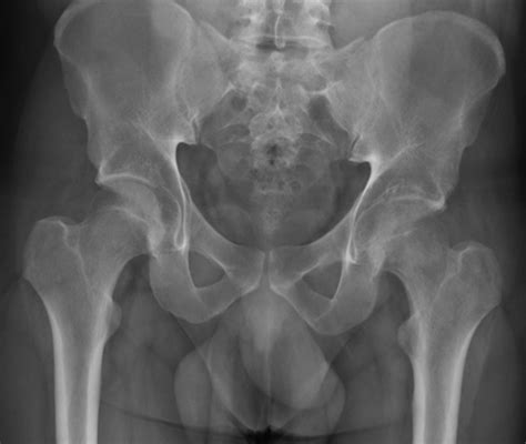 Bilateral Transient Osteoporosis Of The Hip In A 20 Year Old Man