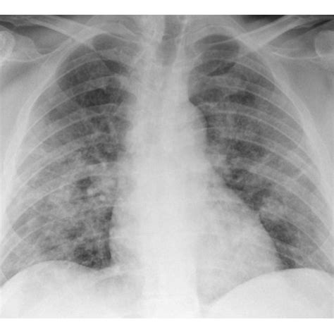 Anteroposterior chest radiographs of the patient during COVID-19... | Download Scientific Diagram