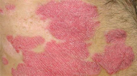 Psoriasis Or Skin Cancer Telegraph