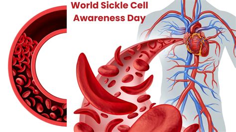 World Sickle Cell Day 2024 Date Darla Emeline