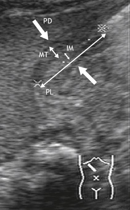 Figure The Dimensions Of The Pylorus Measured On Ultrasonography Im Download Scientific