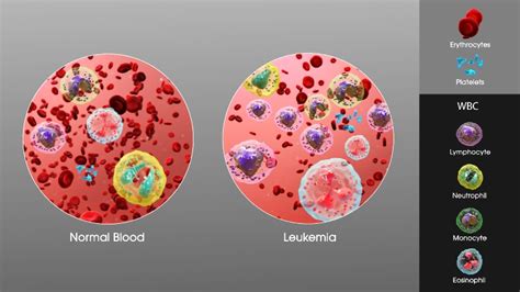 Leukemia Symptoms And Treatment