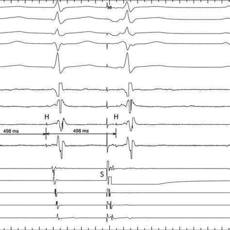 Surface Ecg And Intracardiac Recordings Showing Tachycardia Termination Download Scientific