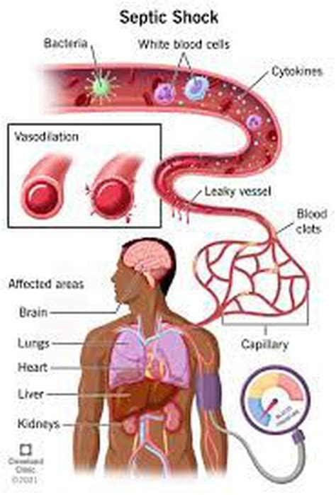 Cause Of Septic Shock Medizzy