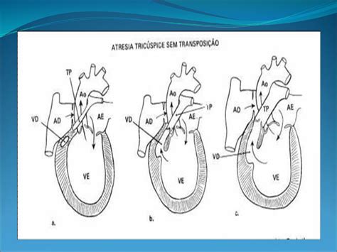 Caso Clinico Atresia Tric Spide Ppt Carregar