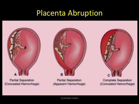 12 Placenta Imaging Dr Ahmed Esawy