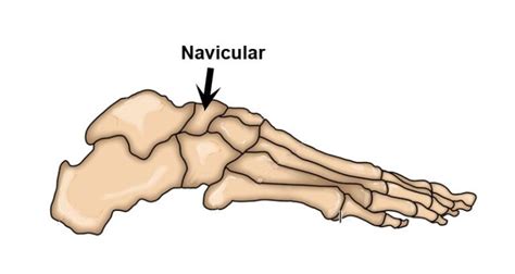 Navicular Stress Fractures Causes Symptoms And Treatment