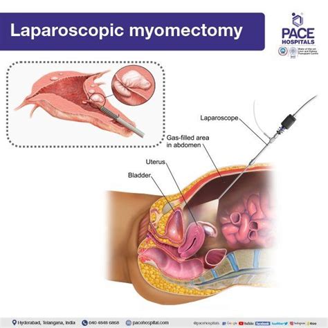 Laparoscopic Myomectomy