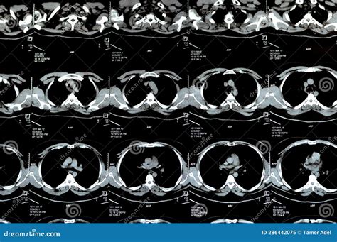 Multi Slice Ct Scan Of The Chest Showing Normal Study Normal